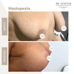 Image of Breast Lift