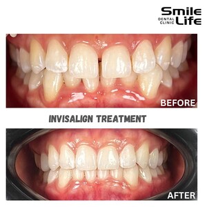 Image of Invisalign treatment