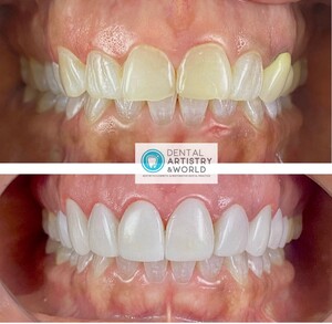 Image of Teeth whitening