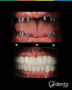 Image of dental implants before and after