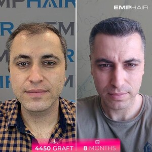 Image of Emphair Hair Transplant Gallery 1