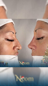 Image of Rhinoplasty - Neom Clinic