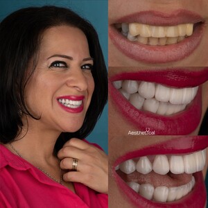 Image of Hollywood Smile - Aesthetical Clinic