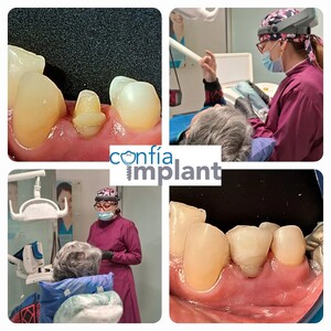 Image of Dental implants