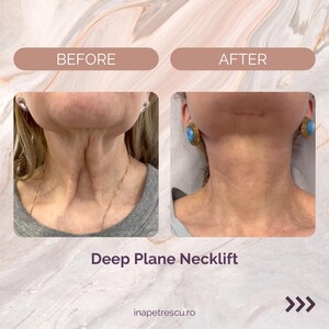 Image of Neck Lift