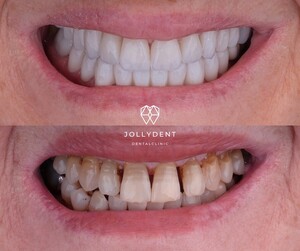 Image of Hollywood Smile - Jollydent