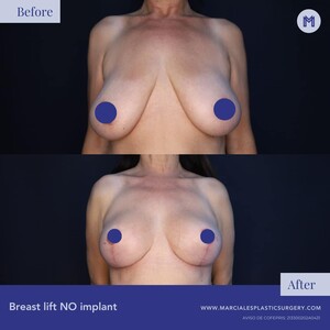 Image of Breast Lift