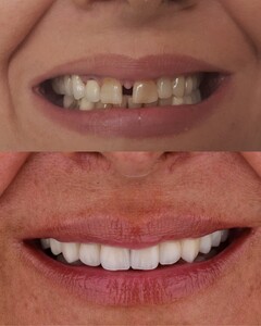 Image of Ceramic crowns