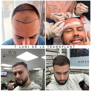 Image of Hair transplantation - Ava Hair Transplant