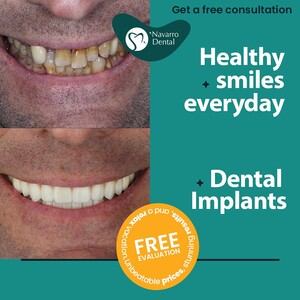 Image of Dental implants