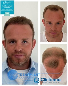 Image of Hair Transplant Solutions Gallery 1