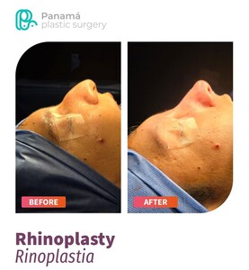 Image of Rhinoplasty