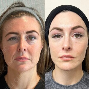 Image of Face and Neck Lift