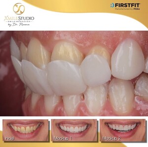 Image of Dental Crowns - Xmile Studio Dental Clinic