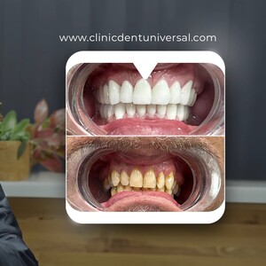 Image of Dental crowns