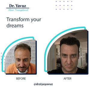 Image of Doctor Ziya Yavuz Hair Transplant Clinic Gallery 3